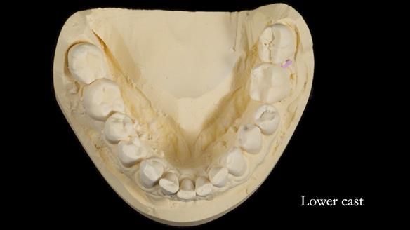 Finlay's Newsletter 64 case study - provision of a Kennedy class 2 metal based Scandinavian RPD for Ian