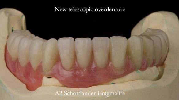 Newsletter 76: Jackie’s case – Telescopic overdenture & precision RPD (the tricky truth!)