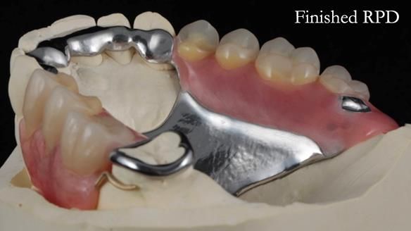 Finlay's Newsletter 60 Sylvia's upper Kennedy Class 2 Mod 1 metal based upper RPD