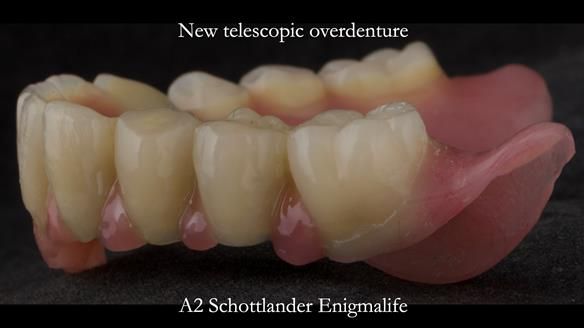 Newsletter 76: Jackie’s case – Telescopic overdenture & precision RPD (the tricky truth!)
