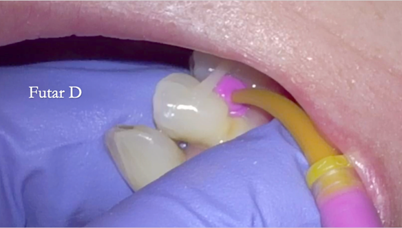 Figure 61 Grade 2 mobile LR4 would move in the impression. To avoid this it was temporarily stabilised with a composite splint and Futar D blocked out underneath to prevent impression tearing