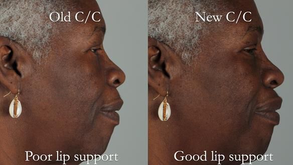 Newsletter 53 showing the making and fitting of ultra life-like dentures for Valena