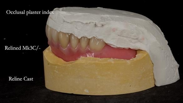 Newsletter 77: Jeremy’s case – immediate complete upper denture