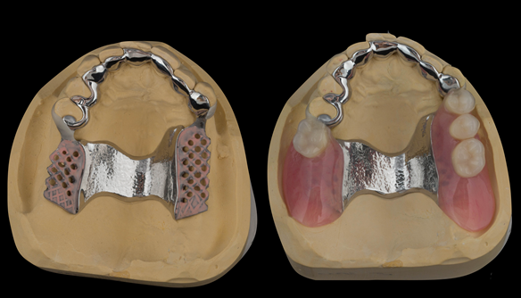 Figure 29 Upper denture cobalt chromium base and finished denture. Optimal extension of saddles and palatal strap for maximum support. Dental bar gives additional support and should teeth be lost in the future this can be added to