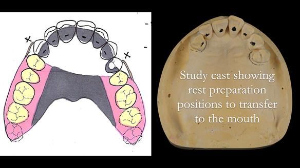 Newsletter 56 showing the making and fitting of a bilateral free end saddle upper removable partial denture (RPD) for patient with pemphigus