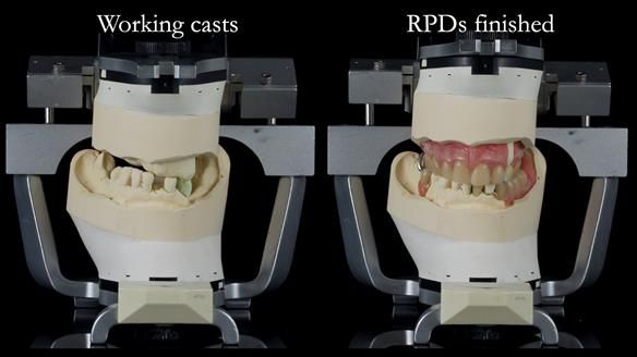 Newsletter 55 Provision of metal based partial dentures for Zephyrine with a repaired cleft lip and palate