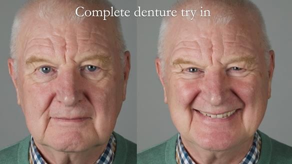 Newsletter 57 showcases the making and fitting process of implant-supported complete dentures for Alisdair
