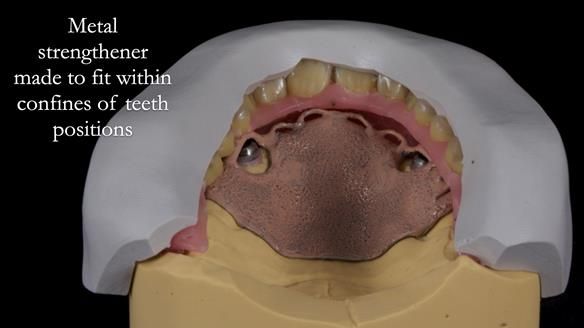 Newsletter 57 showcases the making and fitting process of implant-supported complete dentures for Alisdair