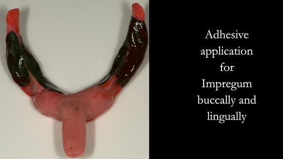 Impregum adhesive applied to labial, lingual and buccal surfaces