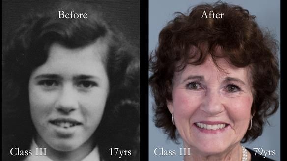 Newsletter 75: Marion’s case - Step-by-step complete denture workflow