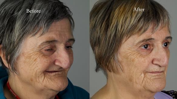 Newsletter 83: Sheila’s Complete Denture Success