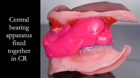 Managing poor implant positioning with complete dentures and Locator attachments - full protocol Newsletter 41