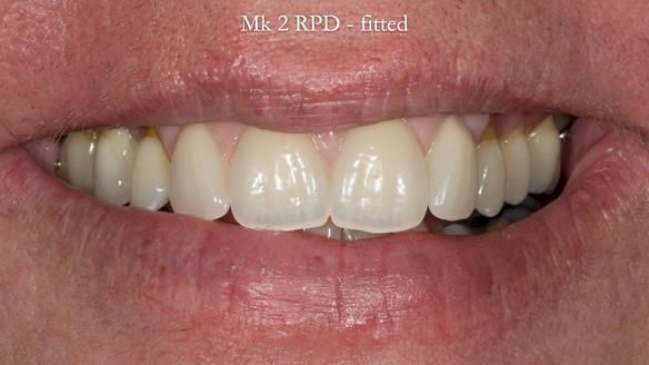 Finlay's Newsletter 63 Case study provision of metal based Scandinavian RPD - functional 10 years on