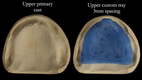Newsletter 83: Sheila’s Complete Denture Success