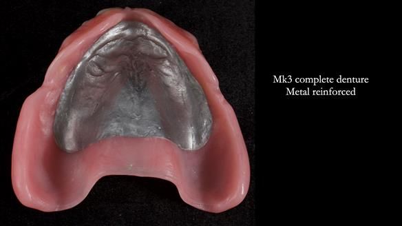 Newsletter 77: Jeremy’s case – immediate complete upper denture