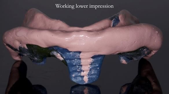 Newsletter 83: Sheila’s Complete Denture Success