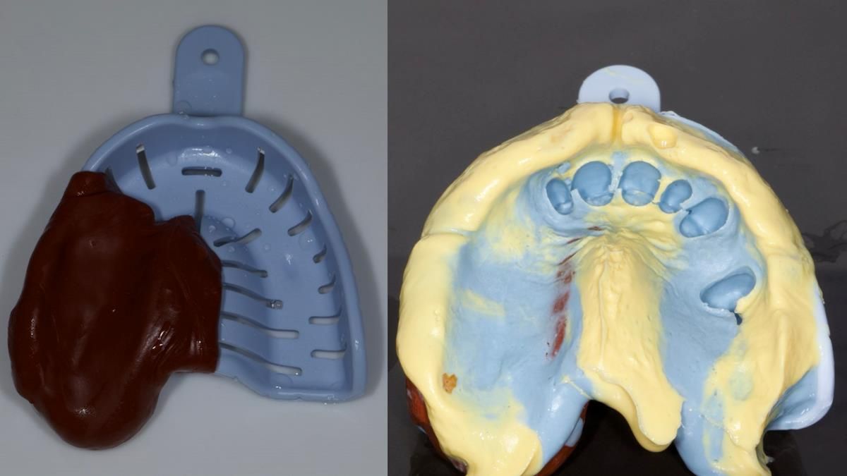 Newsletter 89 – Simon: A Challenging Kennedy Class II Division 1 Upper CoCr Partial Denture with a High Smile Line