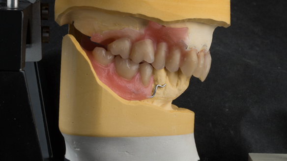 Figure 30 Inflamed soft tissue removed from the cast by me (clinician) as this was swollen soft tissue. Making a flange to fit over this would have bulked the lip out massively. Having it socket fitted instead would result in a lack of peripheral seal and