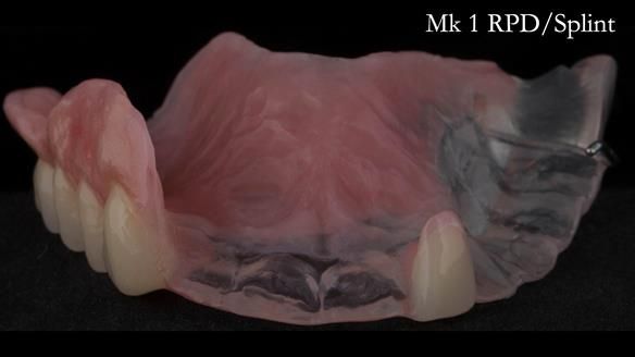 Newsletter 51 Managing Anne’s failing dentition with distal extension base RPD/Splint FULL PROTOCOL