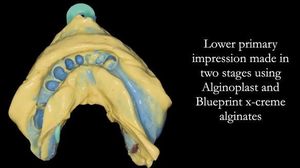Newsletter 55 Provision of metal based partial dentures for Zephyrine with a repaired cleft lip and palate