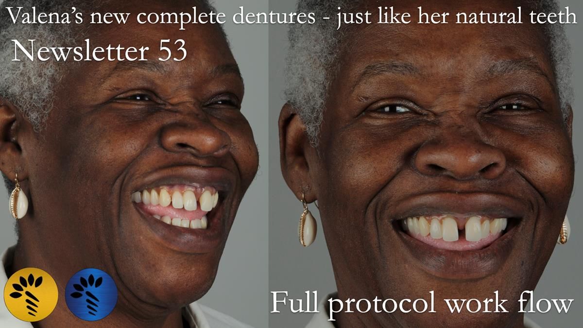 The full protocol workflow is presented including the use of dentate photographs to mimic her beautiful natural teeth.