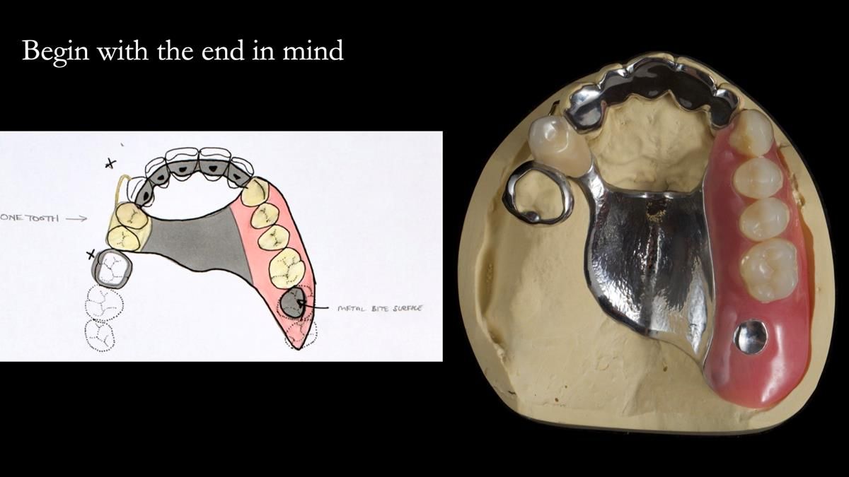 Newsletter 89 – Simon: A Challenging Kennedy Class II Division 1 Upper CoCr Partial Denture with a High Smile Line