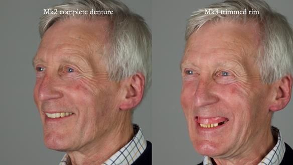 Newsletter 77: Jeremy’s case – immediate complete upper denture