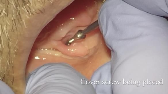 Managing poor implant positioning with complete dentures and Locator attachments - full protocol Newsletter 41