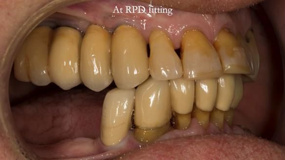 Ken – going downhill, first class