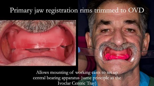 Newsletter 78: What do Clark Gable and a Locator® overdenture have in common?