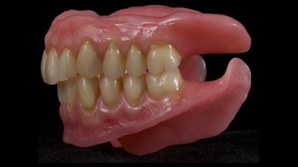 Newsletter 80 - Gordon’s dentures: the one case in 1,000 where my technique failed