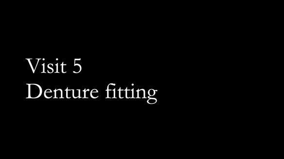Complete denture Class II div 2 deep overbite Newsletter 39