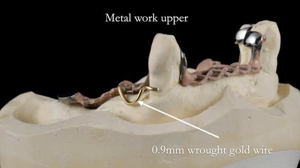 Finlay's Newsletter 59 Ultra hard partial dentures made for Gill
