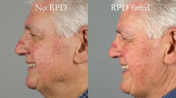 Finlay's Newsletter 64 case study - provision of a Kennedy class 2 metal based Scandinavian RPD for Ian