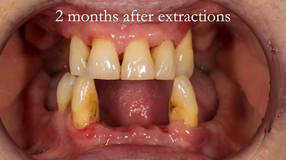 Finlay's Case Study Newsletter 40 - Immediate Mk 1 RPD to Definitive Mk 2 RPD - full protocol