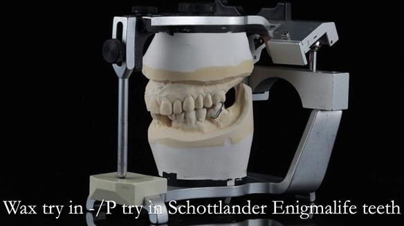 Newsletter 54 case presentation upper complete denture and lower Scandinavian designed hygienic partial denture for David