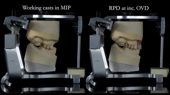 Newsletter 81 - Pam’s Story — how a partial denture changed her life (+ live walkthrough this Thursday)