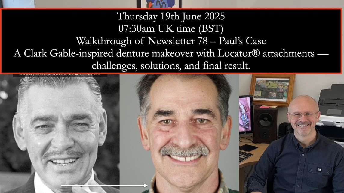 Study Club Live – Paul’s Case: A Clark Gable Smile and Locator Attachments