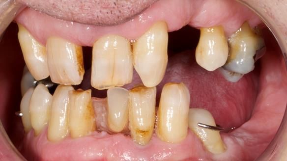Newsletter 86 Peter the Architect — precision removable partial dentures case study
