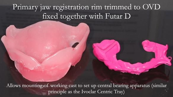 Finlay's Newsletter 58 Gasket upper partial denture for Zoe