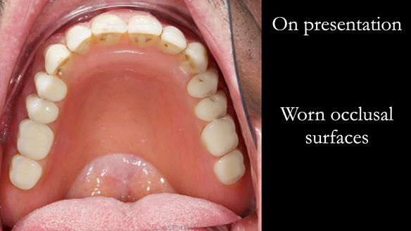Newsletter 78: What do Clark Gable and a Locator® overdenture have in common?