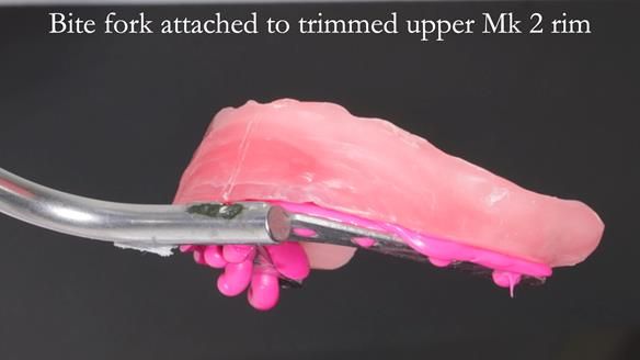 Newsletter 52 Managing Jo’s failing dentition with extractions and Mk 1/Mk 2 complete upper dentures and lower partial dentures FULL PROTOCOL