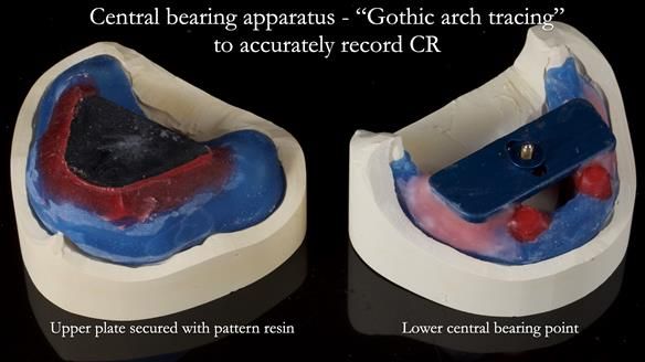 Newsletter 78: What do Clark Gable and a Locator® overdenture have in common?