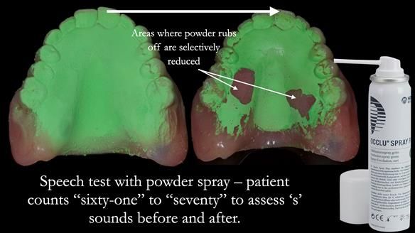 Newsletter 77: Jeremy’s case – immediate complete upper denture