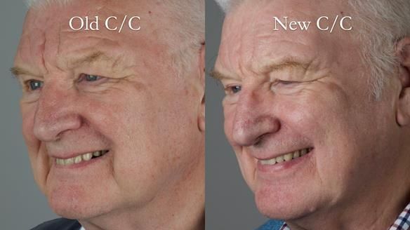 Newsletter 57 showcases the making and fitting process of implant-supported complete dentures for Alisdair