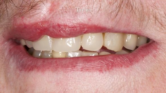 Newsletter 55 Provision of metal based partial dentures for Zephyrine with a repaired cleft lip and palate