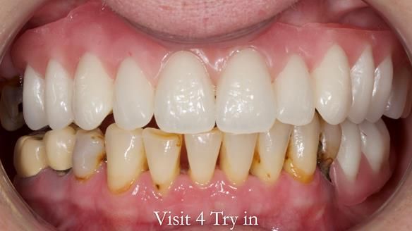 Newsletter 52 Managing Jo’s failing dentition with extractions and Mk 1/Mk 2 complete upper dentures and lower partial dentures FULL PROTOCOL