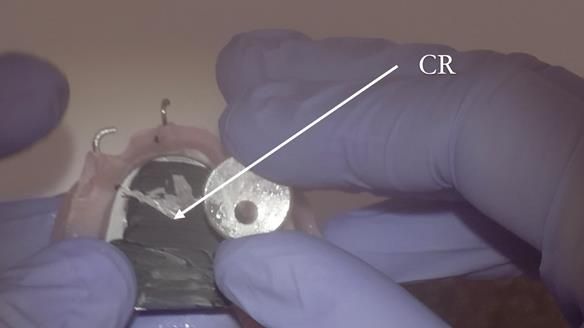 Finlay's Case Study Newsletter 40 - Immediate Mk 1 RPD to Definitive Mk 2 RPD - full protocol