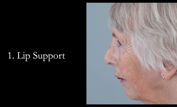 Figure 67 Lip support is prescribed