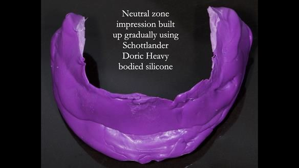 Newsletter 83: Sheila’s Complete Denture Success